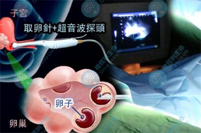 试管婴儿科普：黄体酮在周期中的重要意义——这支“保胎针”，是胚胎着床前后的胜负手